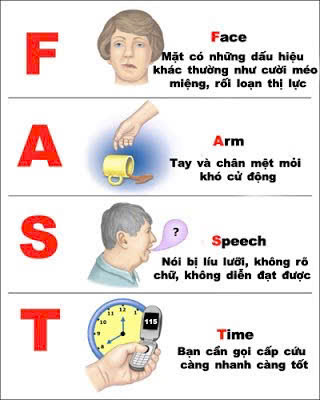  Điều trị đột quỵ nhồi máu não cấp bằng thuốc tiêu sợi huyết đường tĩnh mạch